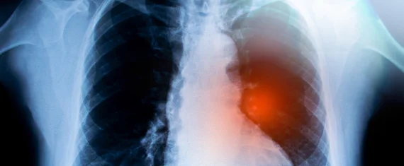 Lung Cancer Detection Application for bioAffinity Technologies